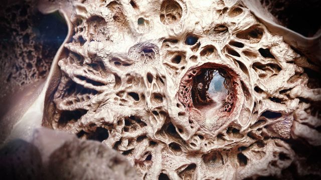 3D Medical Animation Bone Marrow - Glyco